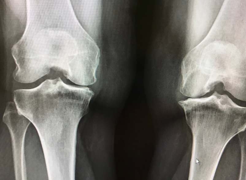 Arthrose du genou : 6.000 pas par jour limite les risques - Sciences et  Avenir